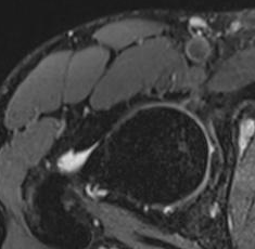 Hip-joint MRI, selected view 1 of 4